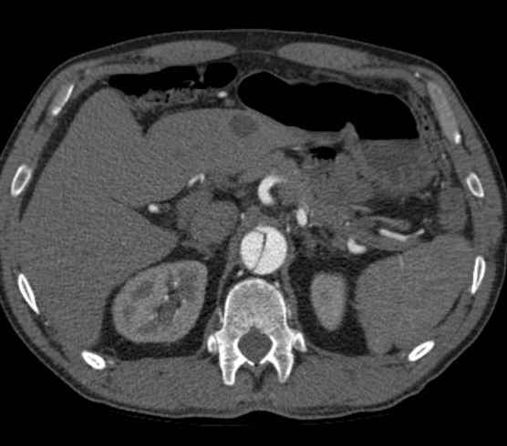 Aortic dissection - Stanford type B (Radiopaedia 73648-84437 A 124).jpg