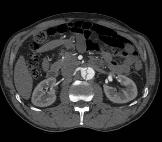 Aortic dissection - Stanford type B (Radiopaedia 73648-84437 A 146).jpg