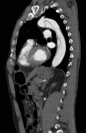 File:Aortic dissection - Stanford type B (Radiopaedia 73648-84437 C 59).jpg