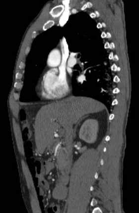 File:Aortic dissection - Stanford type B (Radiopaedia 73648-84437 C 96).jpg