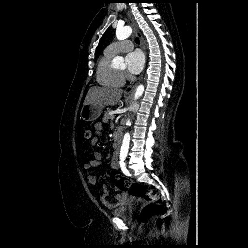 File:Aortic dissection - Stanford type B (Radiopaedia 88281-104910 C 41).jpg