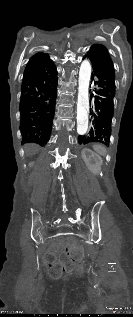 Aortic dissection with extension into aortic arch branches (Radiopaedia 64402-73204 A 63).jpg