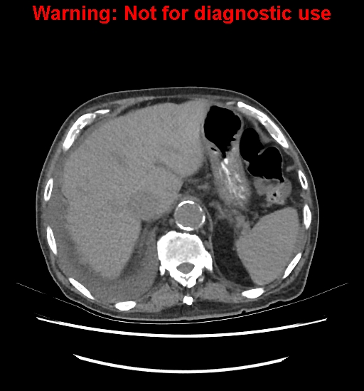 Aortic graft infection (Radiopaedia 44979-48907 Axial non-contrast 26).jpg