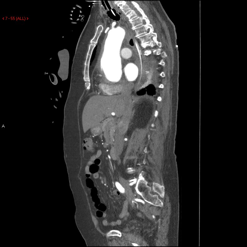 Aortic intramural hematoma (Radiopaedia 27746-28001 C 24).jpg