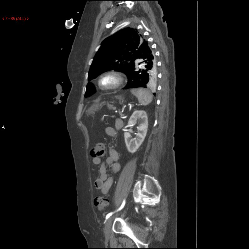 Aortic intramural hematoma (Radiopaedia 27746-28001 C 54).jpg