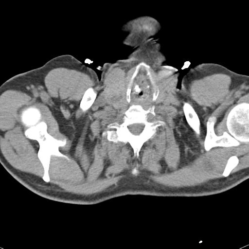 Aortic intramural hematoma (Radiopaedia 31139-31838 Axial non-contrast 1).jpg
