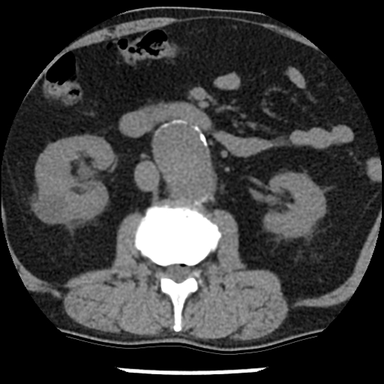 Aortic intramural hematoma (type B) (Radiopaedia 79323-92387 Axial non-contrast 70).jpg