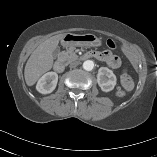 Aortic intramural hematoma from penetrating atherosclerotic ulcer (Radiopaedia 31137-31836 A 102).jpg