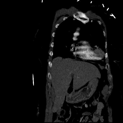 File:Aortic intramural hematoma from penetrating atherosclerotic ulcer (Radiopaedia 31137-31836 C 13).jpg