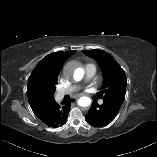 Aortic intramural hematoma with dissection and intramural blood pool (Radiopaedia 77373-89491 B 60).jpg