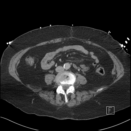 Aortic intramural hematoma with dissection and intramural blood pool (Radiopaedia 77373-89491 E 53).jpg