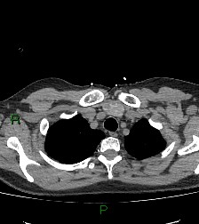 File:Aortic valve endocarditis (Radiopaedia 87209-103485 Axial non-contrast 19).jpg