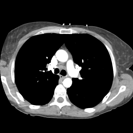 File:Aortic valve non-coronary cusp thrombus (Radiopaedia 55661-62189 B 19).png