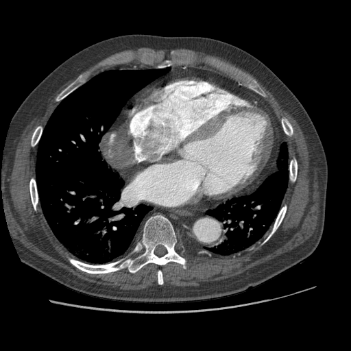 File:Aorto-coronary bypass graft aneurysms (Radiopaedia 40562-43157 A 79).png