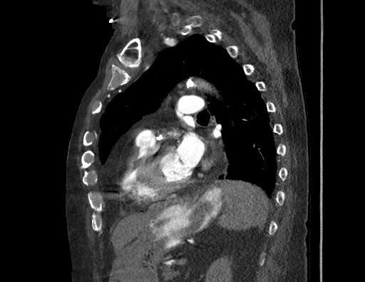 Aortoesophageal fistula with endovascular repair (Radiopaedia 73781-84592 Sagittal C+ CTPA 126).jpg