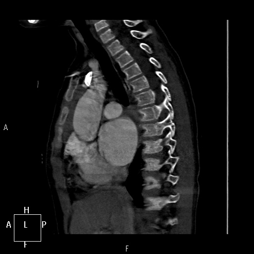 File:Aortopulmonary septal defect (Radiopaedia 41990-45013 Sagittal C+ CTPA 32).jpg