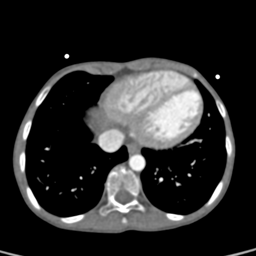 File:Aortopulmonary window, interrupted aortic arch and large PDA giving the descending aorta (Radiopaedia 35573-37074 B 72).jpg