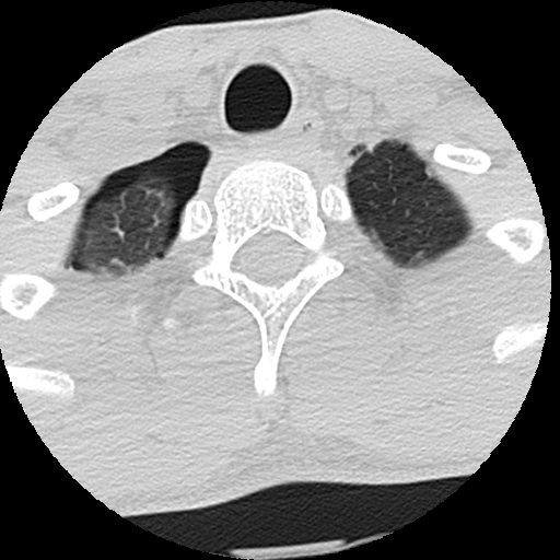 File:Apical pneumothorax on cervical spine CT (Radiopaedia 45343-49368 Axial lung window 7).jpg