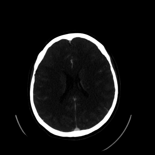 File:Aplasia of the internal carotid artery (Radiopaedia 61082-68960 A 44).jpg