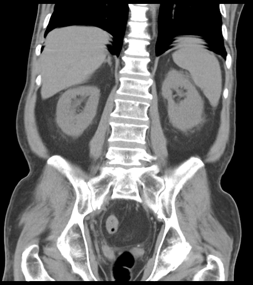 File:Appendiceal abscesses (Radiopaedia 50999-56542 Coronal non-contrast 40).png