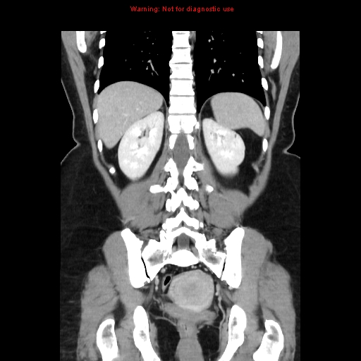 Appendiceal mucinous cystadenoma (Radiopaedia 8263-9111 B 54).jpg