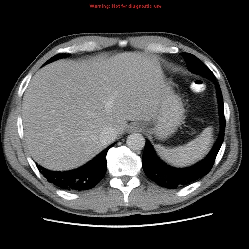 Appendicitis and renal cell carcinoma (Radiopaedia 17063-16760 A 7).jpg