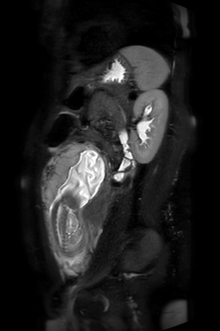 Appendicitis in gravida (MRI) (Radiopaedia 89433-106395 Sagittal T2 SPAIR 20).jpg