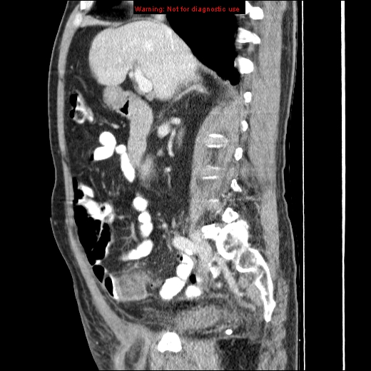 File:Appendicitis mass in inguinal hernia (Radiopaedia 26858-27029 C 21).jpg