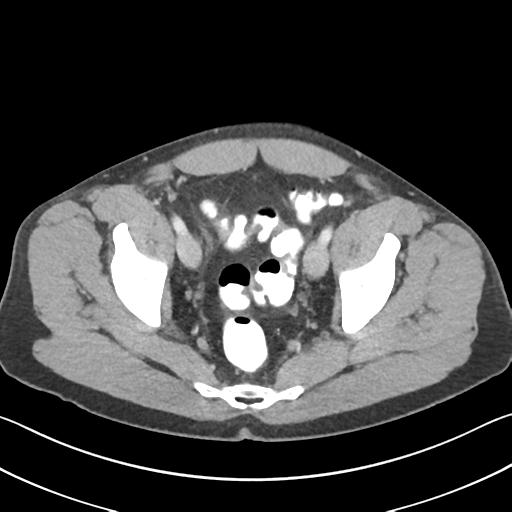 Appendicitis with cecal bar sign (Radiopaedia 31878-32830 B 70).jpg