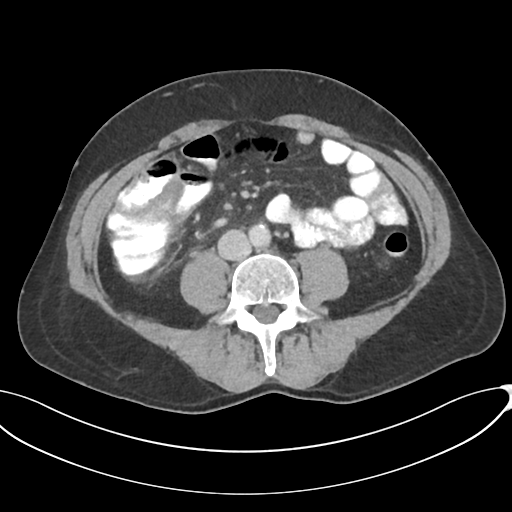 Appendicitis with thickening of the terminal ileum (Radiopaedia 42432-45550 A 59).png