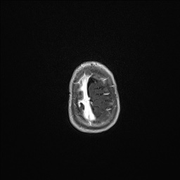 Aqueductal stenosis (Radiopaedia 73974-84802 Axial T1 C+ 137).jpg