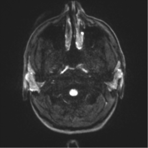 Arachnoid cyst - cerebellopontine angle (Radiopaedia 59689-67083 Axial DWI 37).png