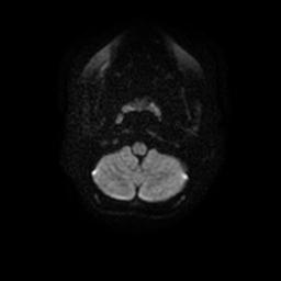 Arachnoid cyst - middle cranial fossa (Radiopaedia 67671-77088 Axial DWI 4).jpg