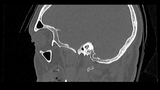 Arcuate foramen (Radiopaedia 89833-106944 Sagittal bone window 123).jpg