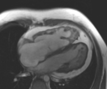 Arrhythmogenic right ventricular cardiomyopathy (Radiopaedia 69431-79307 4ch cine 33).jpg