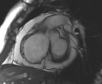 Arrhythmogenic right ventricular cardiomyopathy (Radiopaedia 69431-79307 Short axis cine 192).jpg