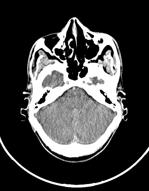 Arrow injury to the brain (Radiopaedia 72101-82607 Axial non-contrast 58).jpg