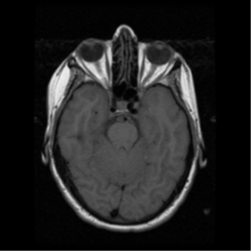 File:Arteriovenous malformation (cerebral) (Radiopaedia 40070-42580 Axial T1 7).png