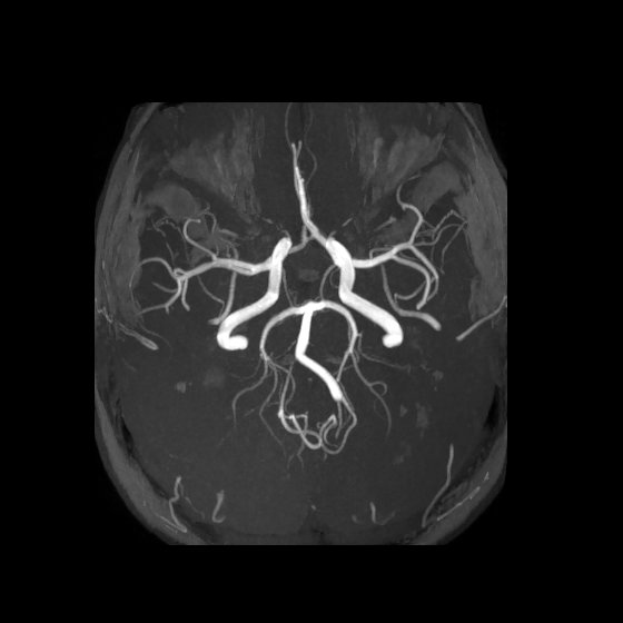 Artery of Percheron infarct (Radiopaedia 40966-43676 F 25).jpg