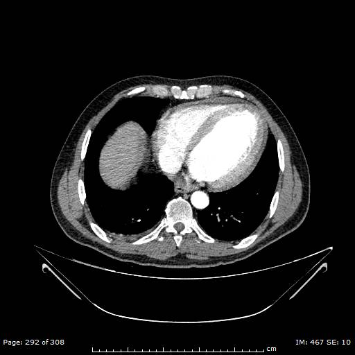 Ascending aortic aneurysm (Radiopaedia 50086-55404 A 74).jpg