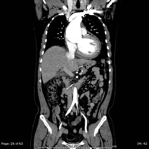 Ascending aortic aneurysm (Radiopaedia 50086-55404 B 26).jpg