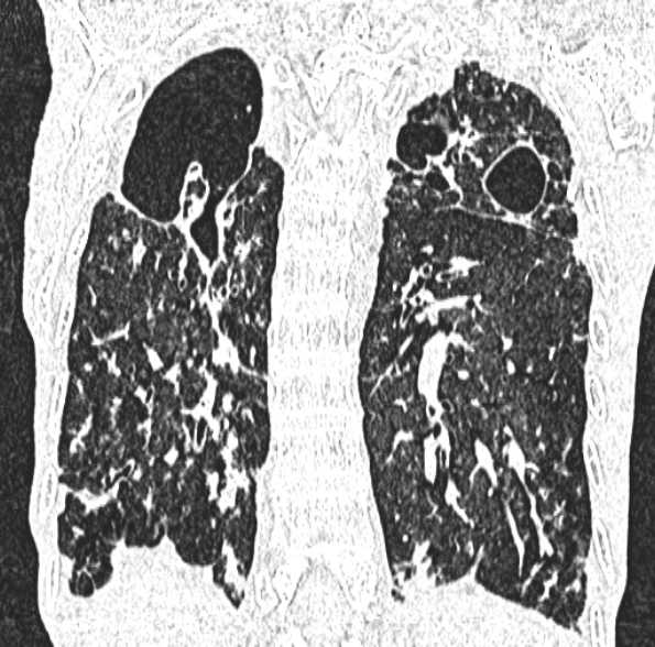 Aspergilloma- with Monod sign (Radiopaedia 44737-48532 Coronal lung window 332).jpg