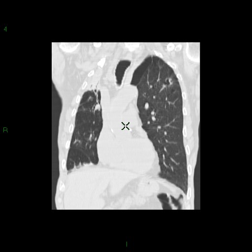 File:Aspergilloma (Radiopaedia 14842-14787 Coronal lung window 14).jpg