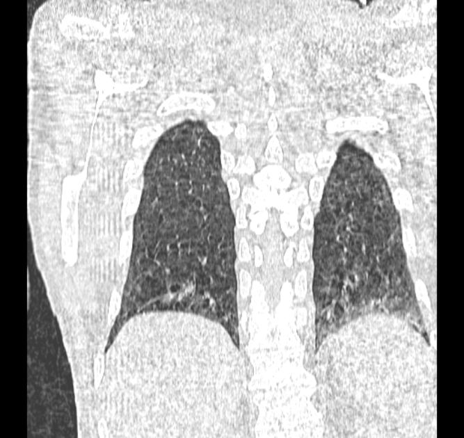 Aspergilloma (Radiopaedia 44592-48327 Coronal lung window 111).jpg