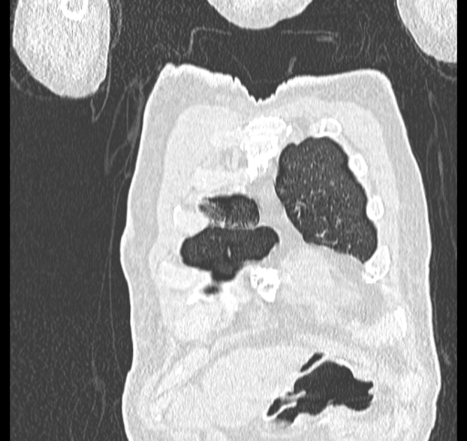 Aspergilloma (Radiopaedia 44592-48327 Coronal lung window 2).jpg