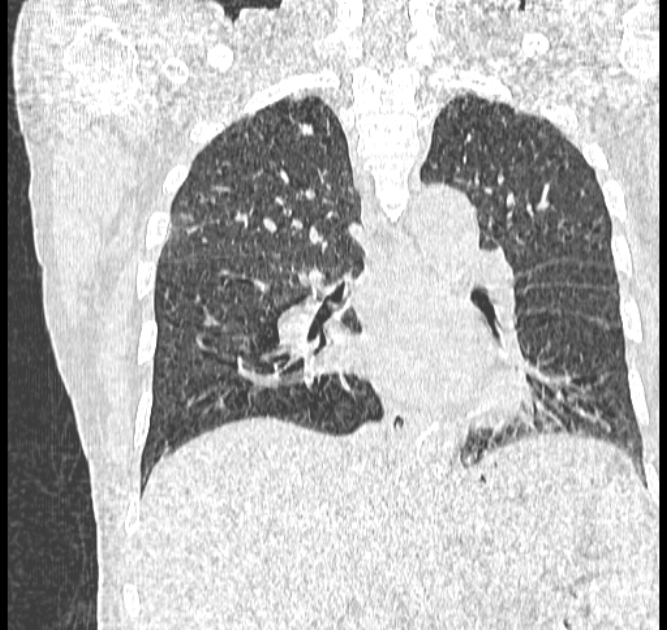 Aspergilloma (Radiopaedia 44592-48327 Coronal lung window 77).jpg