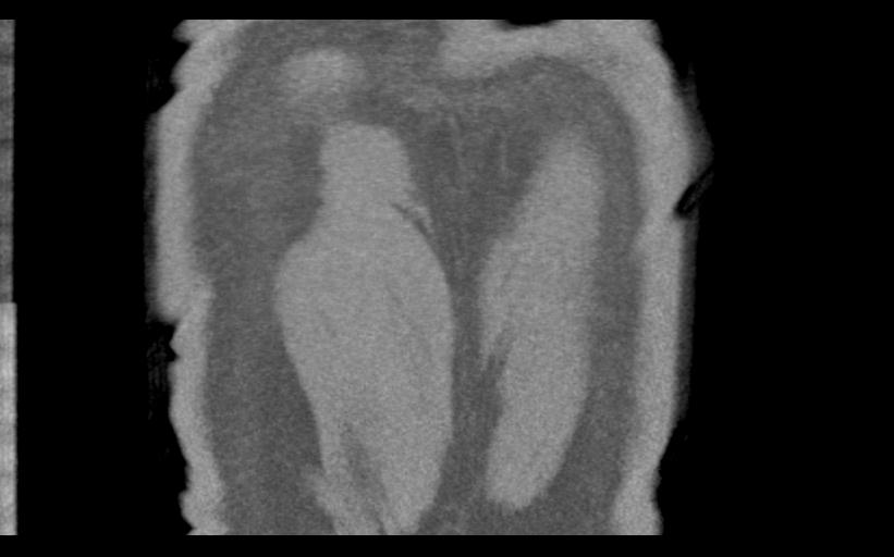 Aspirated tooth (Radiopaedia 28584-28844 Coronal C+ CTPA 79).jpg