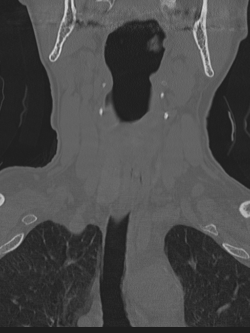 Atlanto-axial subluxation (Radiopaedia 36610-38176 Coronal bone window 6).png