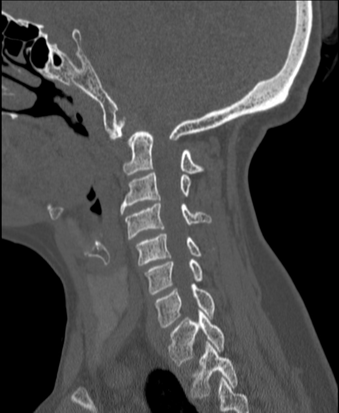 Atlanto-occipital assimilation with basilar invagination (Radiopaedia 70122-80188 Sagittal bone window 37).jpg