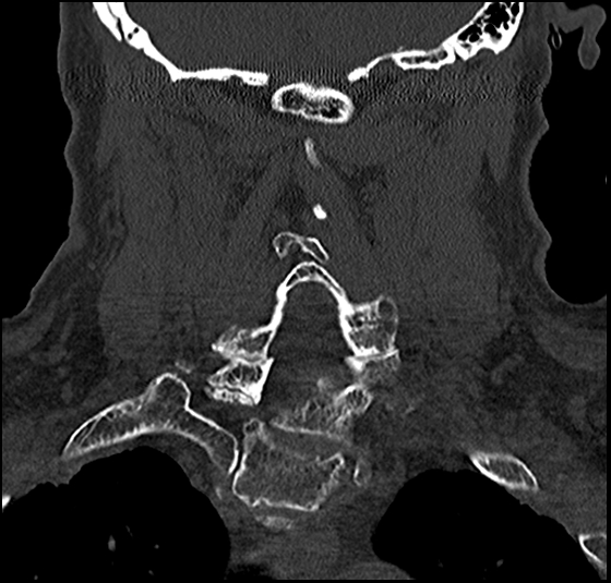 File:Atlas (type 3b subtype 1) and axis (Anderson and D'Alonzo type 3, Roy-Camille type 2) fractures (Radiopaedia 88043-104607 Coronal bone window 39).jpg